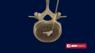 StabiliT® Vertebral Augmentation System [upl. by Maria]