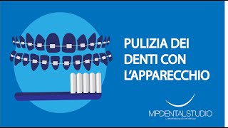 Come pulire i denti con lapparecchio fisso [upl. by Luella]