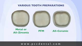 Ask Gordon Crown tooth preparation technique [upl. by Sirapal543]