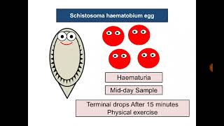 Urine Analysis 17 Schistosoma haematobium eggs [upl. by Laure]