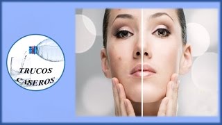 Como eliminar las cicatrices del acne con productos naturales caseros [upl. by Aoniak]