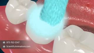 Dental Sealants  Tooth Decay Treatment [upl. by Aridnere]