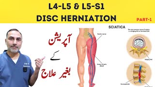 L4  L5 and L5 S1 Disc Herniation Treatment  Slip Disc Treatment At Home sciatica [upl. by Mingche]