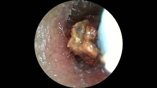 Insane Ear Wax Removal with Camera Tool [upl. by Phenice]