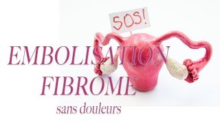 Traitement des Fibromes Utérins Sans Chirurgie grâce à lEFU Sans Douleur [upl. by Blunt8]