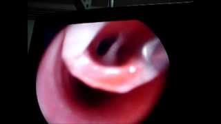 Bronchoscopy Rigid for Foreign body Whistle [upl. by Ortensia836]