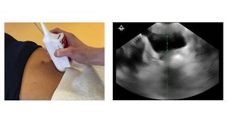 Echographe vésical  Bladder Scanner Vitascan LT [upl. by Kcirdnek]