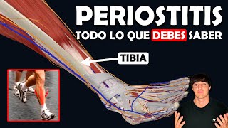 PERIOSTITIS TIBIAL Su TRATAMIENTO y lo que debes saber [upl. by Anirb131]