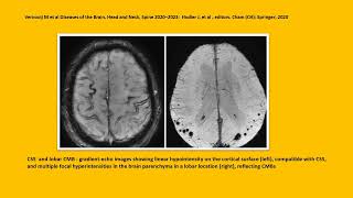 NEUROLOGY QUIZ 69 Cerebral Amyloid Angiopathy CAA [upl. by Ydnerb]