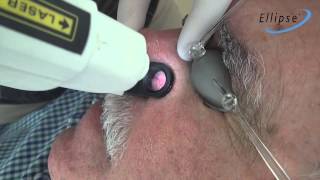 Tratamiento telangiectasias faciales con Ellipse NdYAG [upl. by Baudoin549]