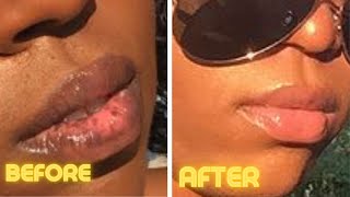 How I Treat My Lip Discoloration  2021 Lip Routine To Save Money [upl. by Denys]