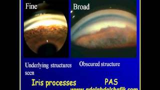 Gonioscopy Lecture part 4 [upl. by Akihsan]