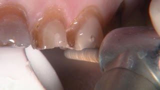 Chairside Live Episode 112 Restoring Severely Stained Preparations with BruxZir® Solid Zirconia [upl. by Miharba]