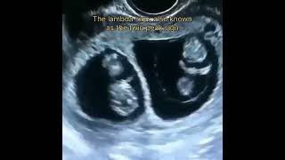 Twin Pregnancy viralvideo baby pregnant health ultrasoundscans [upl. by Luapnhoj]