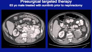 What is the role for cytoreductive surgery in the treatment of metastatic renal cell carcinoma [upl. by Lorry141]