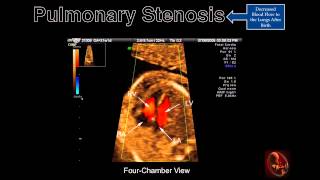 Fetal Echocardiography Pulmonary Stenosis [upl. by Sprung]