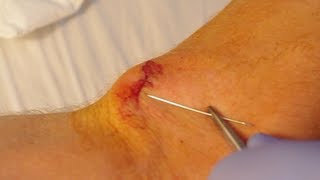 How To Give Yourself Stitches Sutures [upl. by Akihsay]