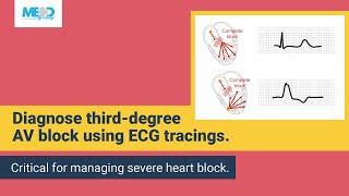 Examining a thirddegree AV block [upl. by Namreg]