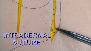 7 Surgical Sutures Intradermal Suture [upl. by Ahsinelg558]