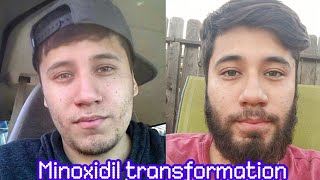 Minoxidil Beard Transformation Officially 2 years [upl. by Phineas]