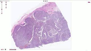 Papillary Renal Cell Carcinoma  Histopathology [upl. by Velvet553]