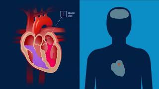 Medtronic Gunasekarans Cryoablation Journey [upl. by Nairb]