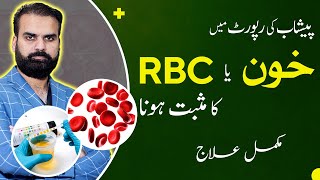 Blood in Urine or High RBCs in Urine Test Causes Symptoms amp Treatment [upl. by Quenby]