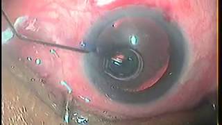 High Quality Cataract Surgery  Intratunnel Phacofracture MSICS in Grade 4 Nuclear Cataract HD [upl. by Luoar]