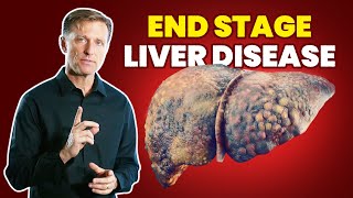 10 Signs of a Dying Liver End Stage Liver Disease [upl. by Changaris920]