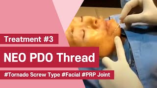 NeoGenesis Thread Series PDO Tornado Screw Type Facial Joint Procedure with PRP [upl. by Etnovad359]