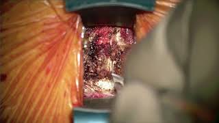 Cervical Disc Replacement with MobiC for Treatment of Cervical Disc Herniation [upl. by Socem]