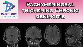 Pachymeningeal thickening Chronic meningitis [upl. by Neerhtak]