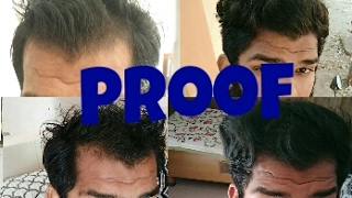 Proof of hair regrow naturally [upl. by Horowitz]