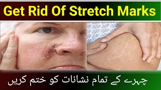 Stretch marks removal serum  stitches scars reduce serum  Dr review fade scars serum [upl. by Ennaoj567]