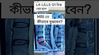 কোমরের L4L5L5S1 ডিস্কের সমস্যা MRI তে কিভাবে বুঝবেন জনে নিন MRI discprolapse lowbackpain [upl. by Ainattirb]