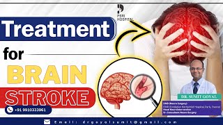 Treatments for Brain Stroke by Dr Sumit Goyal brain treatment neurology neurologist delhi [upl. by London]