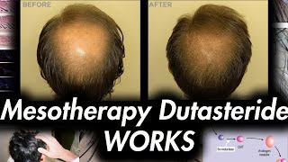 Mesotherapy Dutasteride What to expect Hair loss reversal [upl. by Anaihk]