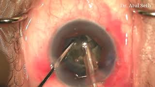 B HEX in Uveitic Cataract  Dr Atul Seth  Eyemax Superspeciality Eye Centre [upl. by Samal]