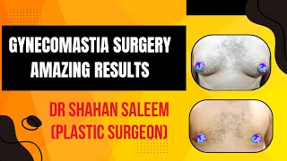 Gynecomastia Surgery for flat chest [upl. by Yenaffit457]