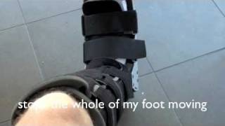 Stress Fracture 2nd Metatarsal [upl. by Belvia]