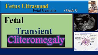 Fetus Ultrasound Fetal Transient Cliteromegaly [upl. by Beaston252]