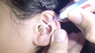 School Girls Impacted Dry Earwax Removal [upl. by Dumah456]