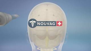 Craniotomy Nouvag [upl. by Lemaceon53]