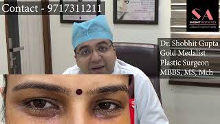 What is Xanthelasma Removal Treatment  Dr Shobhit Gupta Xanthelasma Laser Removal Before and After [upl. by Droflim]