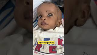 Hydrocephalus  ventricles of brain  normal pressure hydrocephalus  youtubeshorts [upl. by Aicilana]