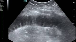 Bedside Ultrasound for the Diagnosis of Small Bowel Obstruction JETem 2017 [upl. by Aikit]