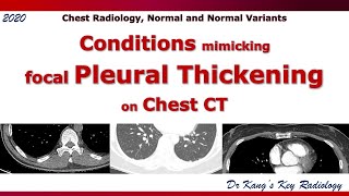 Pleural thickening mimickers CT [upl. by Nevar]