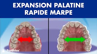 Expansion palatine rapide MARPE  DISJONCTEUR ORTHODONTIQUE chez ladulte © [upl. by Melba]