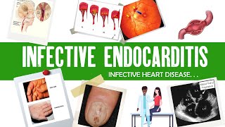 Infective Endocarditis  Dukes criteria  definition causes symptoms complications amp treatment [upl. by Alyehc297]