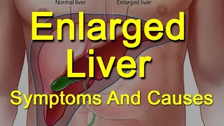 Enlarged Liver Symptoms And Causes  What Is Hepatomegaly [upl. by Aretahs617]